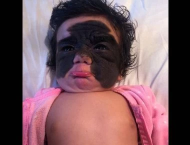 Μωρό – «Mπάτμαν» - Το σπάνιο και μαύρο σημάδι που το κάνει ιδιαίτερο (φώτο-βίντεο)